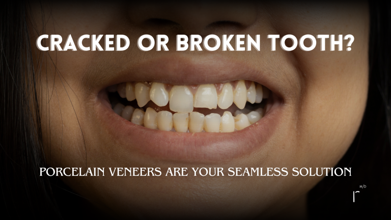 Veneers and Crowns: A Seamless Solution For Chipped or Broken Teeth