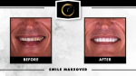 Before and after smile makeover completed at Restore Modern Dentistry in Bentonville, Arkansas, featuring a cosmetic dentistry transformation with brighter, natural-looking teeth for a patient in Northwest Arkansas.